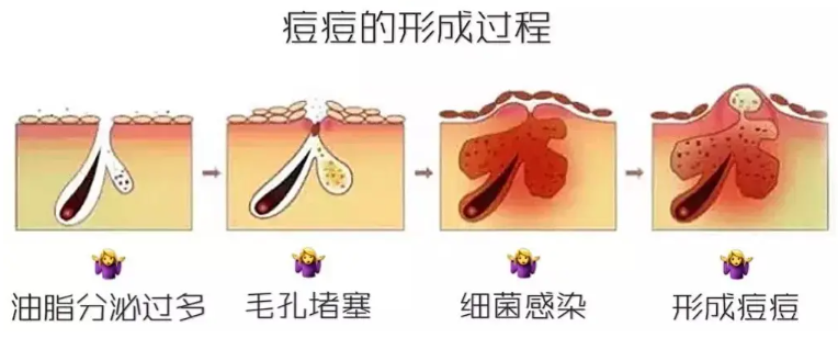 日常我們的皮膚問題有哪些？閉口、粉刺、痘痘~