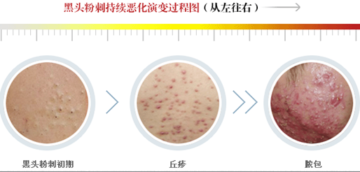 日常我們的皮膚問題有哪些？閉口、粉刺、痘痘~